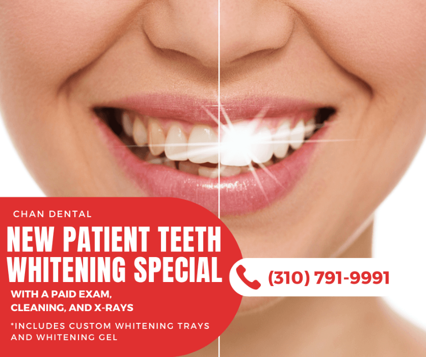 New Patient Teeth Whitening Special in Torrance, CA